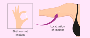 Any Methods of contraception suits ME Implants Subdermal | subcutaneous contraceptive