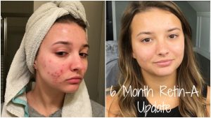 ACRETIN CREAM || اكرتين كريم acne