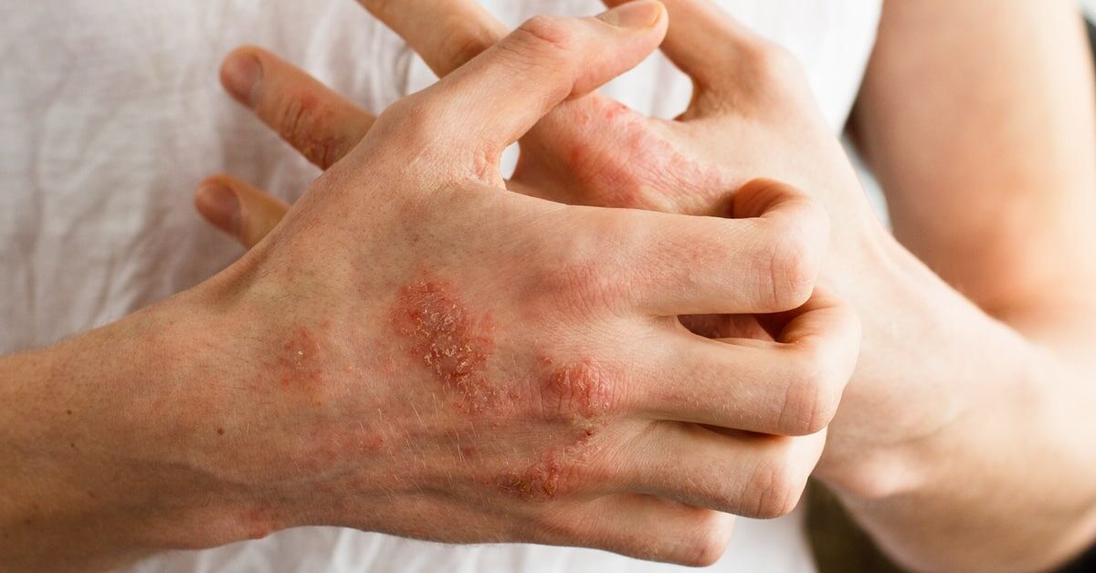 Psoriasis is a common disease in winter .. Learn about the causes and the different treatment methods مرض الصدفية