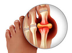 COLMEDITEN 100TAB gout
